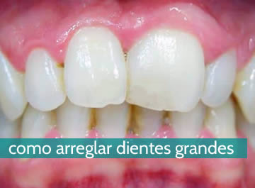 Cómo arreglar dientes grandes