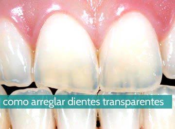 ¿Cómo arreglar dientes transparentes?