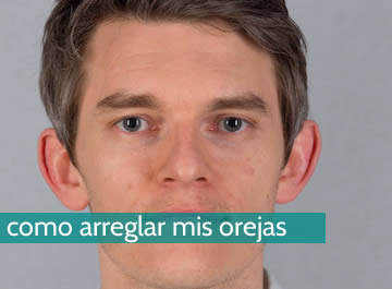 Cómo arreglar mis orejas