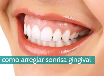 ¿Cómo arreglar sonrisa gingival?