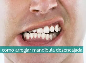 Cómo arreglar mandíbula desencajada