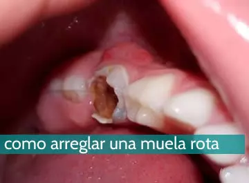 Cómo arreglar una muela rota