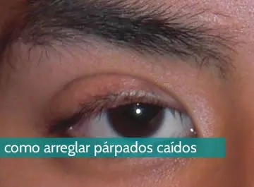 Cómo arreglar parpados caídos