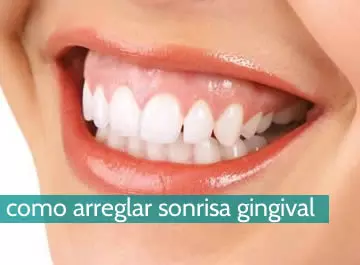 Cómo arreglar sonrisa gingival